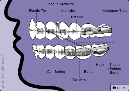 Parts of Your Braces